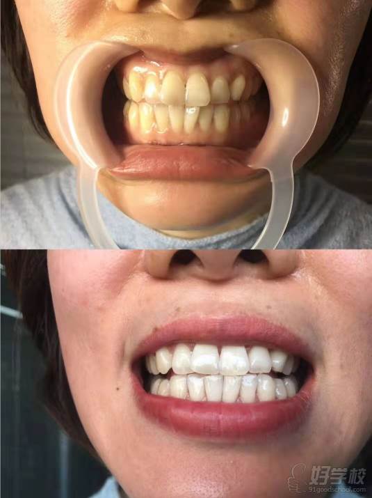 导读:上海阿洛美前牙美学设计中心引进瑞士牙齿美学原研技术,结合