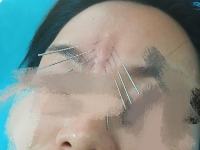 被女明星追捧的针灸美雕改善川字纹的实操手法