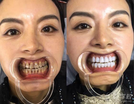 广州秀尔国际美容培训中心  美牙专业技术作品效果对比