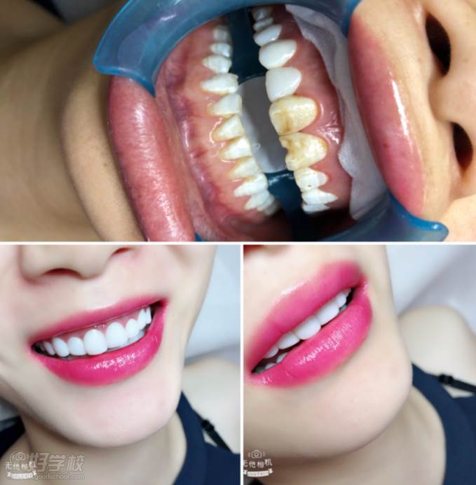 广州秀尔国际美容培训中心  问题牙齿处理效果展示