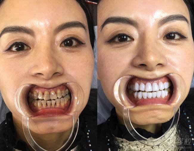 广州秀尔国际美容培训中心  牙齿美白效果