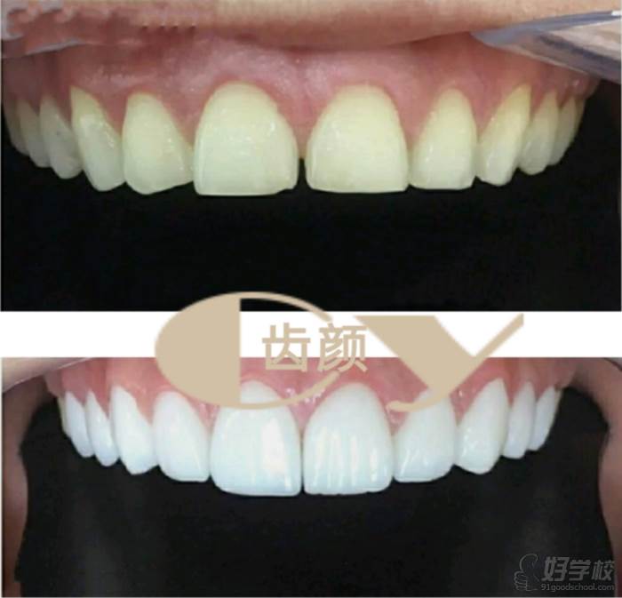 上海CyikO齿颜培训中心  美牙技术效果对照