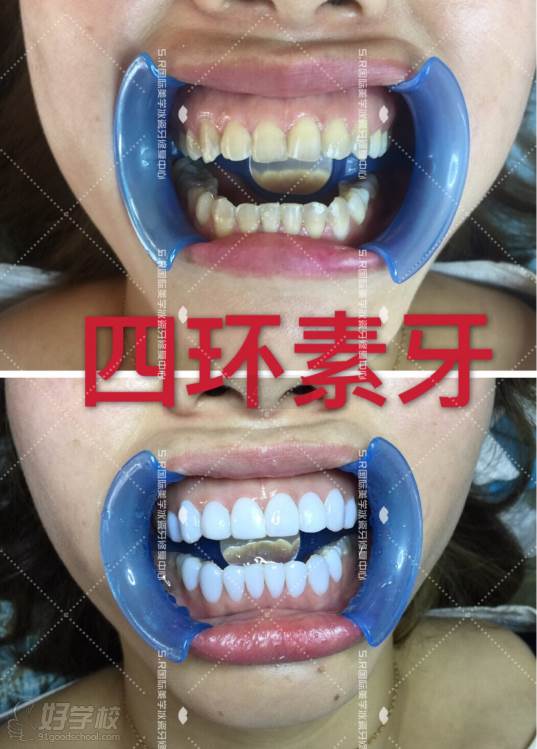 南京S.R国际冰瓷牙美白修复培训中心  美牙作品之四环素牙