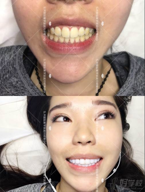 南京S.R国际冰瓷牙美白修复培训中心  美牙作品图