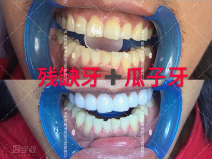 南京S.R国际冰瓷牙美白修复培训中心  美牙作品对比之残缺牙V瓜子牙