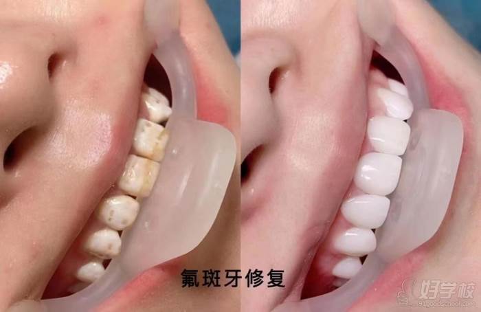 氟斑牙修复