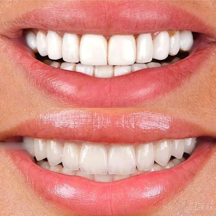 标准牙齿图正常图片