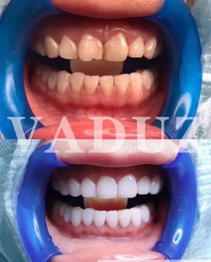  牙齿修复技术