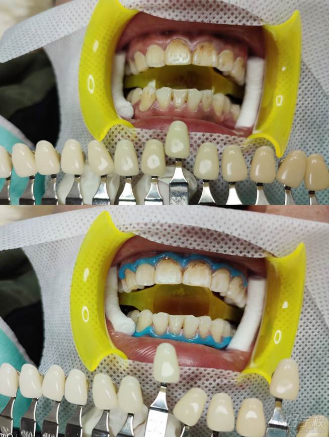 牙齿护理效果对比