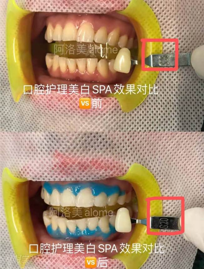 牙齒美白效果前后對(duì)比