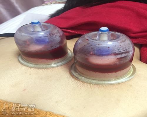 上海王式中医推拿针灸培训学校刺血实践展示